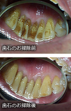 歯石を超音波で除去